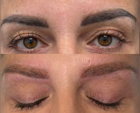 Sopracciglia prima e dopo la rimozione laser del trucco semipermanente — caso della Dott.ssa Rubinia Russo